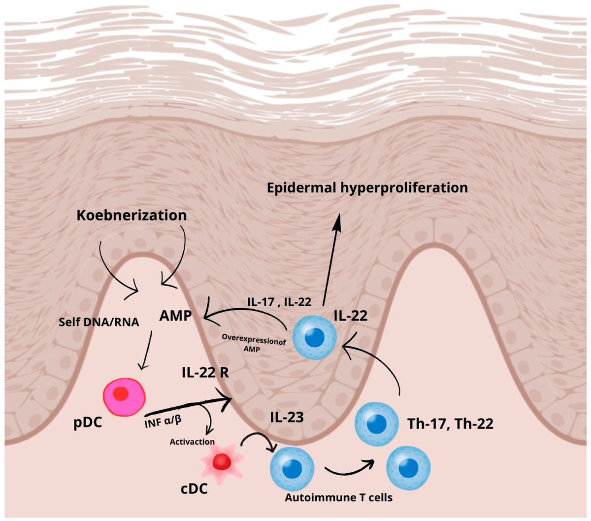 🔔#Allergies_MDPI Welcomes you to read our publication "New Therapies in the Biological Treatment of Psoriasis: A Review" by Mr. Mateusz Kamil Ożóg et al.

✅Link: brnw.ch/21wWnDa

#Psoriasis #ChronicInflammation #AutoimmuneDisease #SkinHealth #PsoriaticArthritis