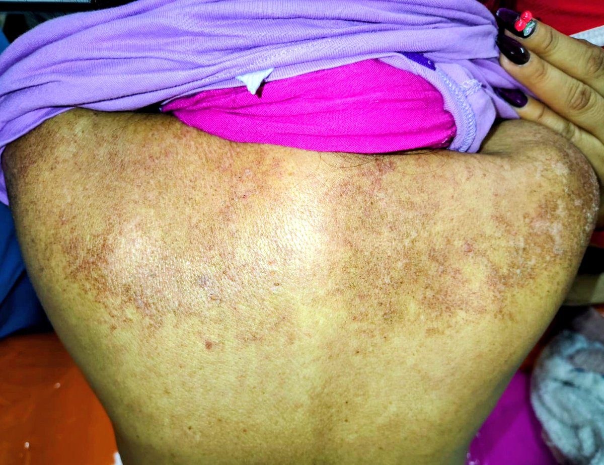 ConsejosReumato's tweet photo. La #dermatomiositis causa #miopatía proximal y elevación de enzimas musculares. A nivel dérmico se observan lesiones típicas como #heliotropo , #rashmalar , pápulas de #Gottron y lo que se ve en esta paciente con DMT, lesiones hipercrómicas en dorso superior (signo "del manto"). https://t.co/huSp72LXK8