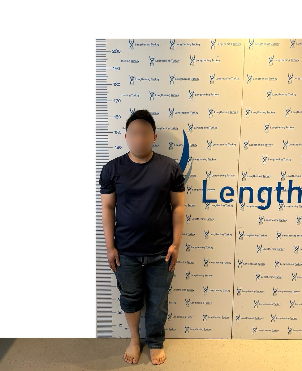 lengtheningtr's tweet photo. 🇺🇸 A new journey begins!
Our patient from the USA has arrived in Istanbul to undergo Quadrilateral Surgery (Precice + LON).

📅 Surgery Date: Tomorrow
📏 Goal: +14 cm in 3 months

This is one of the most advanced and challenging transformations — lengthening both femurs and tibias for maximum height increase. With our expert team, careful planning, and intensive physiotherapy, we’re ready to make his dream a reality. 🌍✨

Stay with us as we share his progress from tomorrow onwards — every step, every centimeter. 🚀

Thinking about surgery?
Let our expert team guide you step-by-step to safe and symmetrical results.

📩 DM us to get your free consultation!
📞 WhatsApp: +905330164562
🌐 https://t.co/RPAIt97on2
📷 Follow us for real results, patient stories, and more!
- 
PROFESSIONAL LEG LENGTHENING

#LegLengthening #Precice #LON #Quadrilateral #HeightSurgery #LengtheningTurkey
#FITBONE #骨延長 #Beinverlängerung #腿延长 #lengtheningturkey #limblengthening #heightsurgery #脚延長手術 #allongementdesjambes