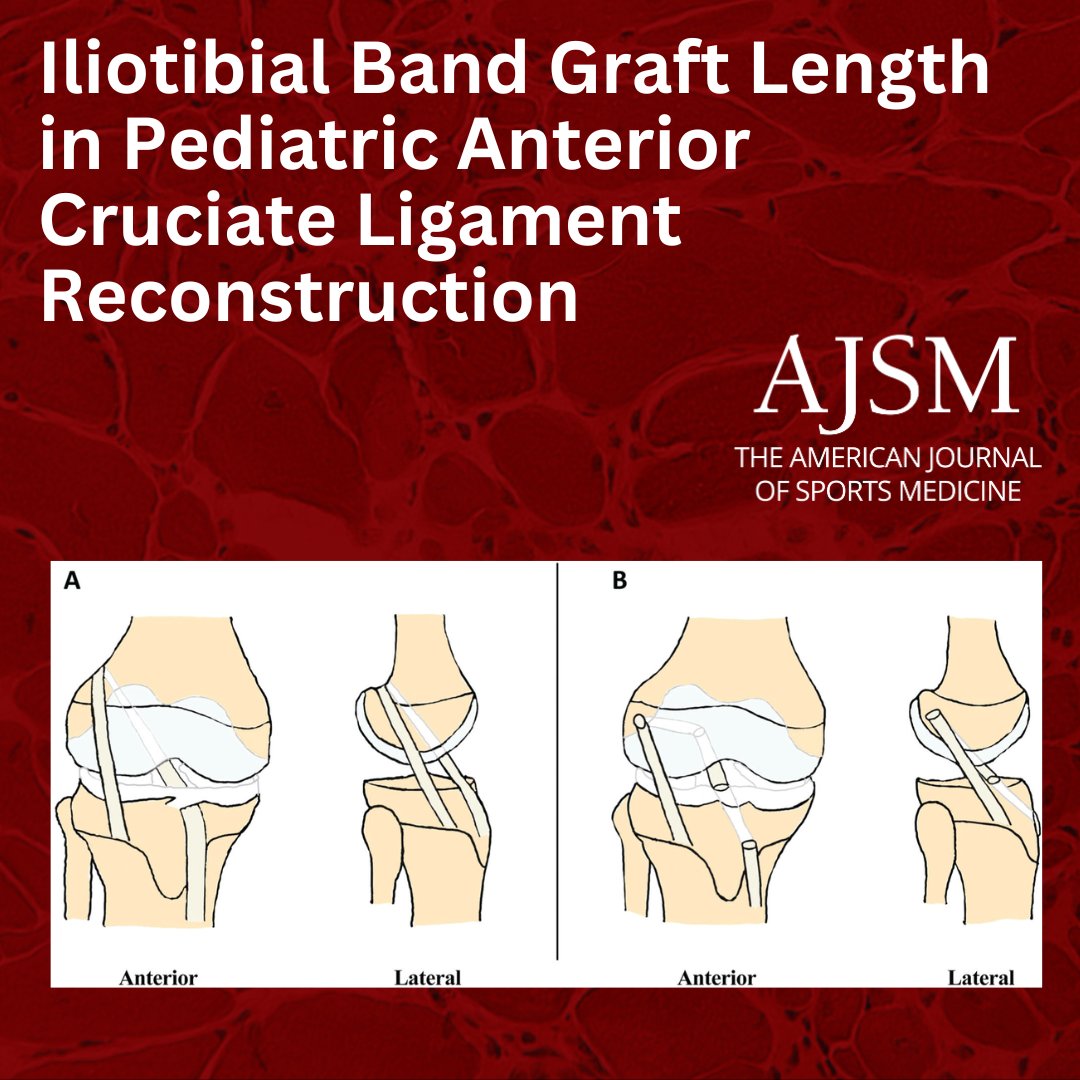 New study compares ITB graft length in pediatric ACLR: All-epiphyseal technique = shorter grafts! Could this reduce donor site complications? 🦵🏽 

 doi.org/10.1177/036354…

#PedsOrtho #ACLR <a href="/NneomaDuru/">Nneoma O. Duru, MD</a> <a href="/posna_org/">POSNA</a> <a href="/stanfordmed/">Stanford Medicine</a> <a href="/AAOSmembers/">Richard Spiers</a>