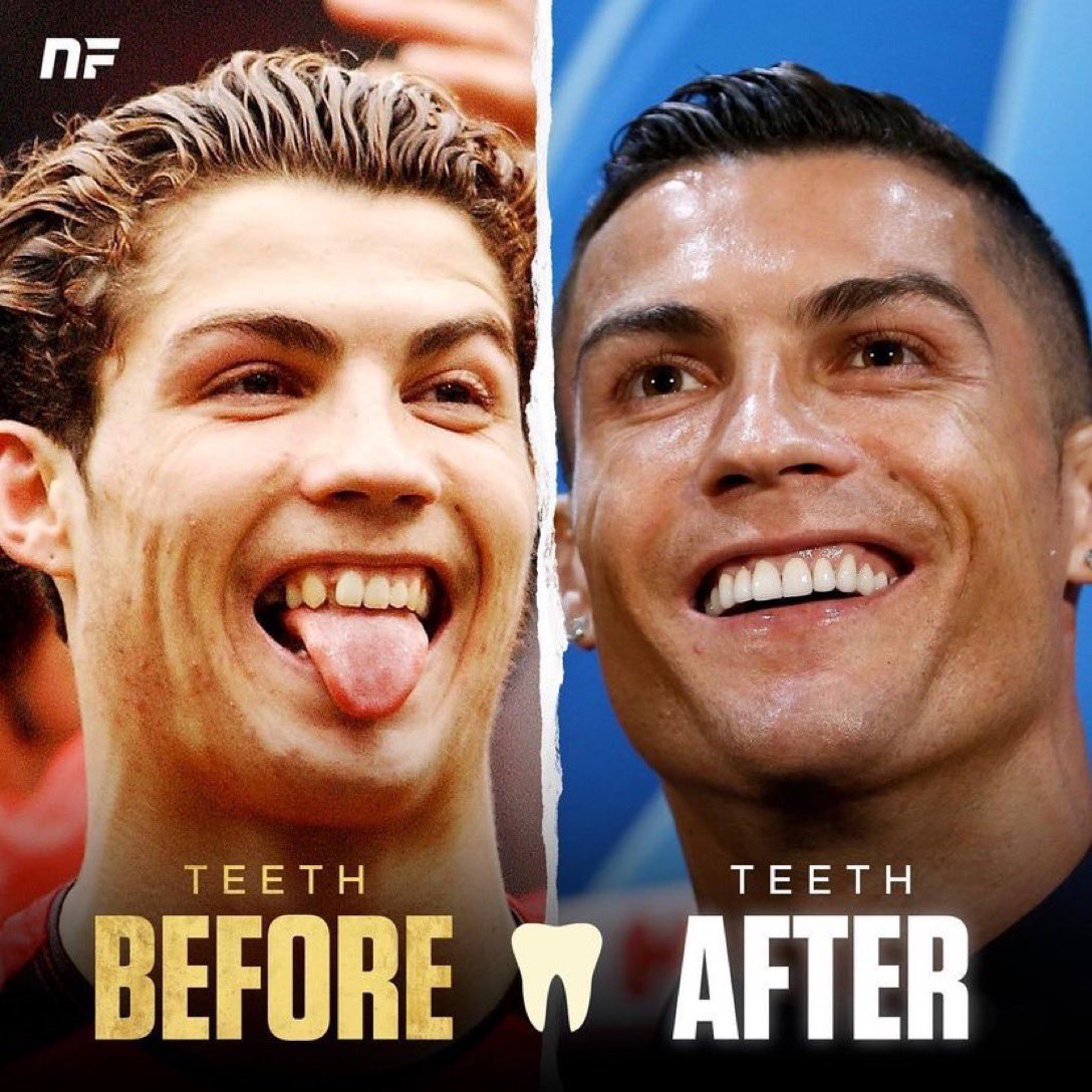 footballers and coaches who have had teeth transformations 🦷😁.

A THREAD 🚨.

1. Cristiano Ronaldo