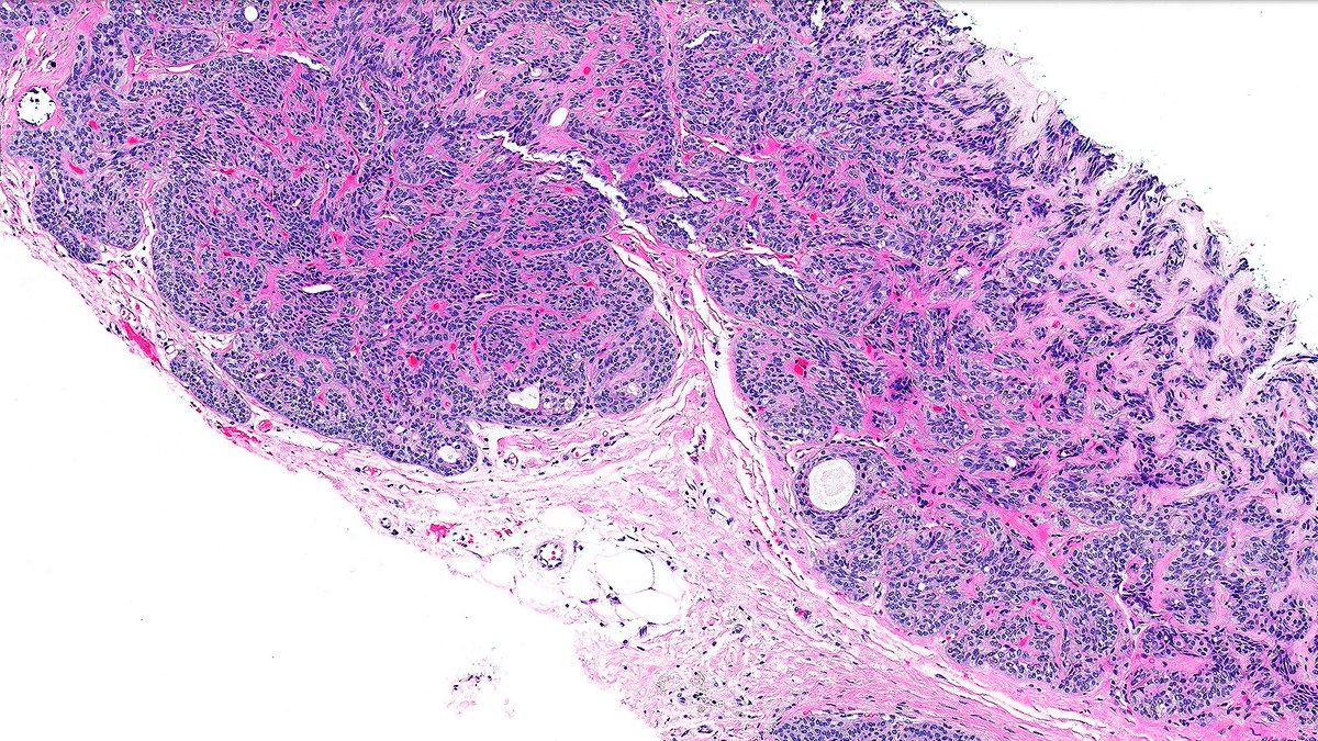 Let’s review sclerotic and fibrotic 🗿 lesions of the breast

Case of Adenomyoepithelioma 🔬

Biphasic proliferation of epithelial + myoepithelial cells with anastomosing sclerosis.

#PathX #PathTwitter #breastpath