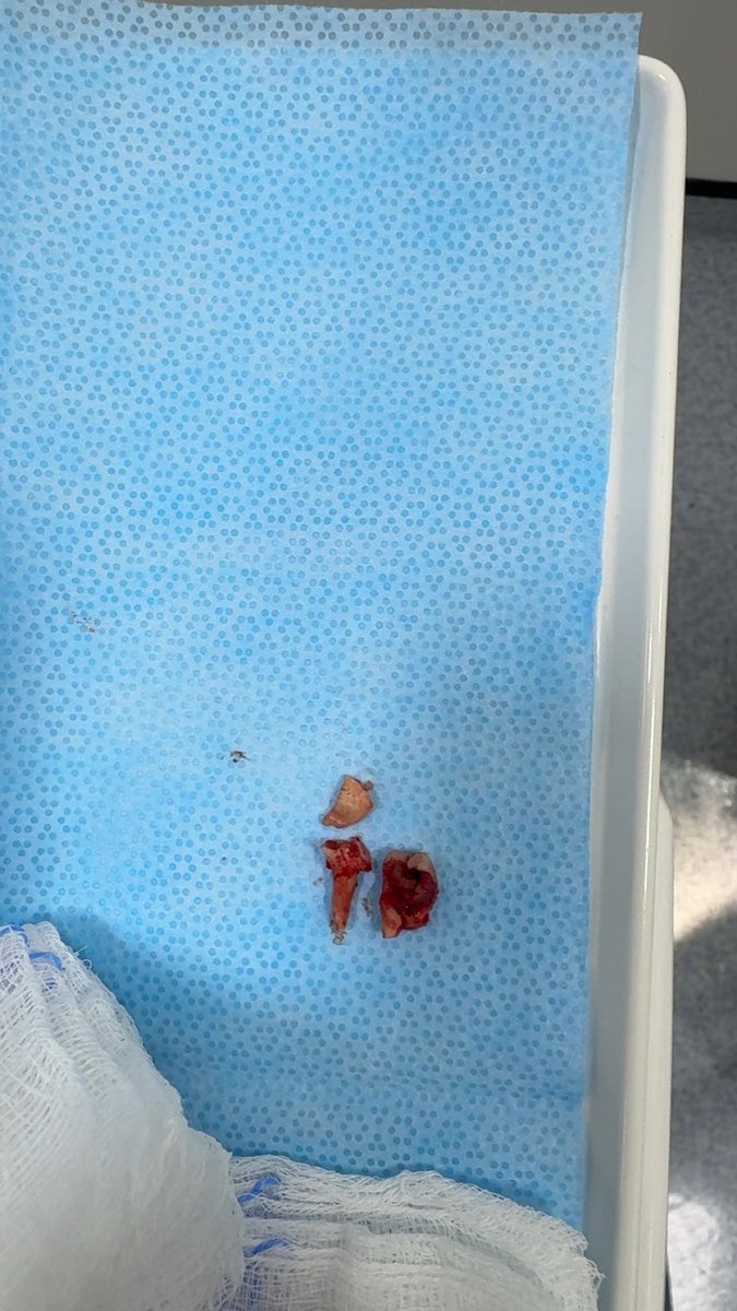 Simple extraction of #37 and surgical extraction of #48.