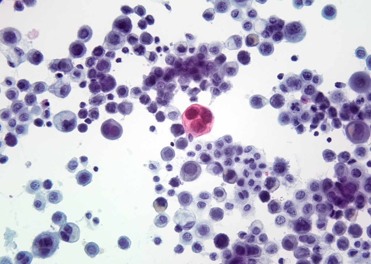 Another classic appearance - "Perakeratotic-like" cell in pleural effusion of a mesothelioma. (cytospin)