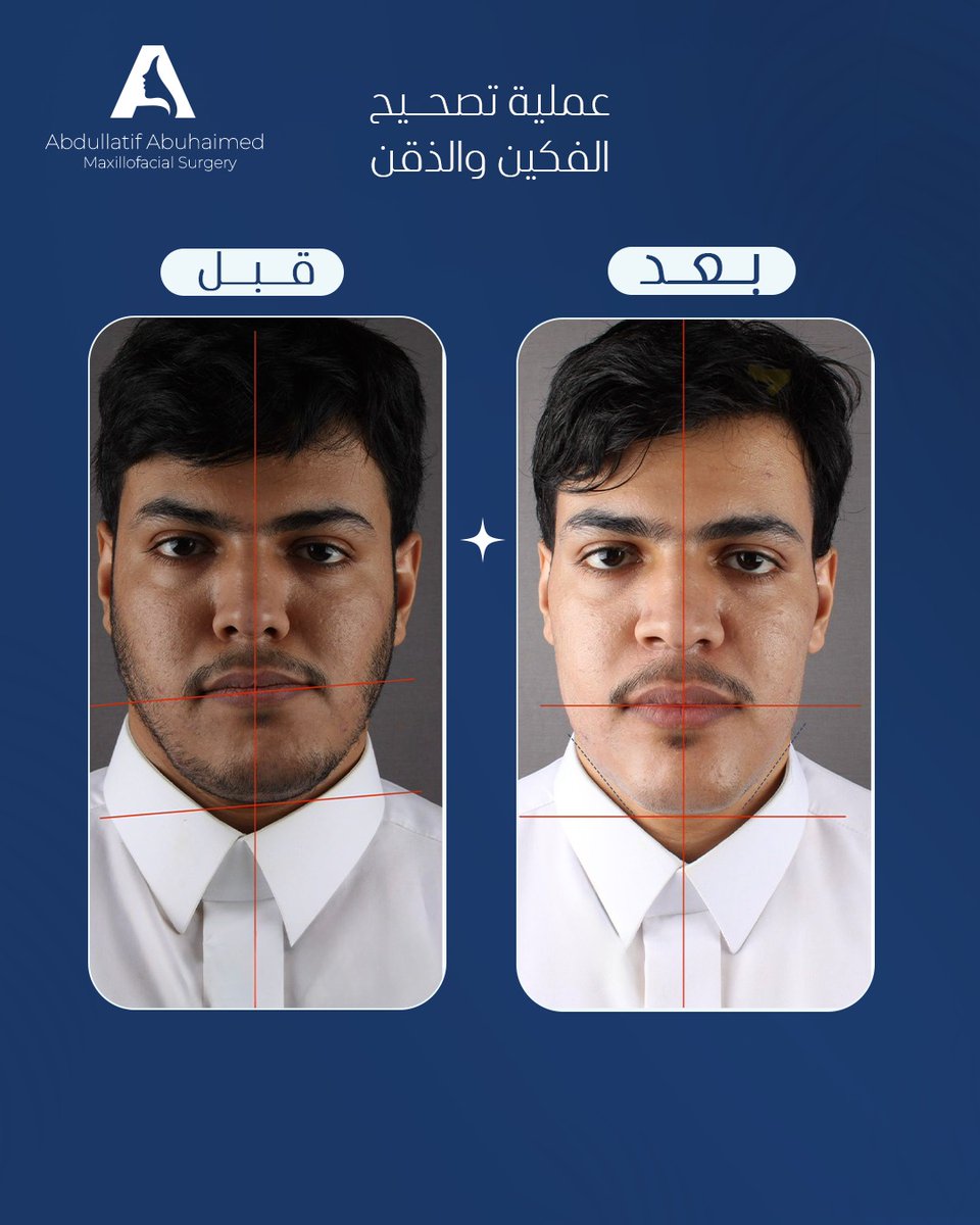 عملية تصحيح الفكين والذقن 

للاستشارات الطبية المتخصصة و الحجز 
عن طريق رقم التنسيق 📞 : +966552474730 
د. عبداللطيف أبوحيمد 🧑‍⚕️
استشاري جراحة الوجه والفكين
#BeyondBalance

#الصحة #الصحة_العامة #الوجه #الفكين #الرياض #الاطباء