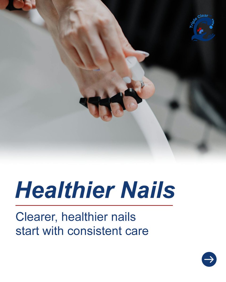 TripleClearHF's tweet image. See real results with Triple Clear HF! 🌿

Clearer, stronger, healthier nails start with consistent care.

Target brittleness &amp;amp; peeling naturally.

Transform your nails now! 💅

#TripleClearHF #VisibleResults #HealthyNails #ClearNails #NailTransformation #NaturalCare