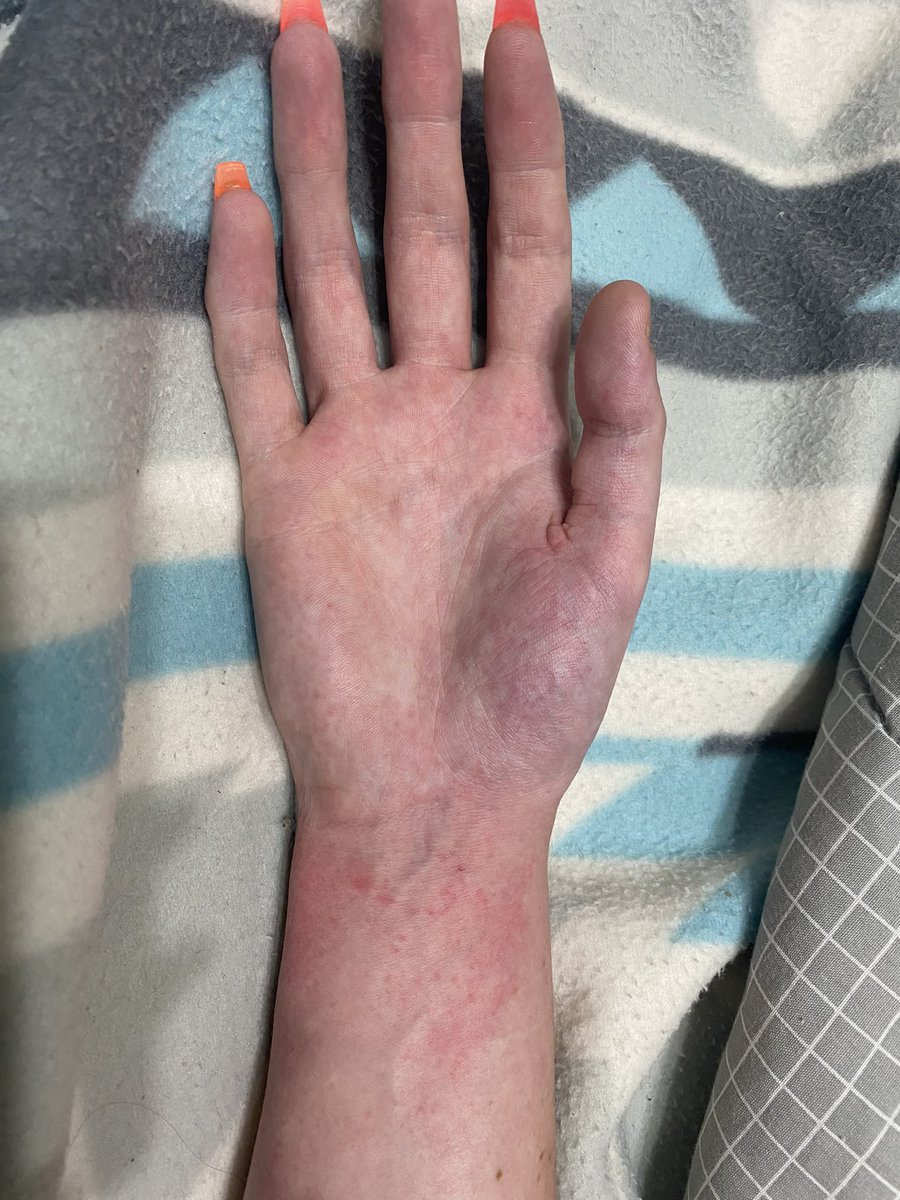 ChronicallyJen_'s tweet photo. The joys of CRPS……

It’s crazy to me to realise that for the last 5 years… I’ve been in a minimum of 6/10 pain every second of the day for 5 years 

I also deal with 5 other chronic illnesses….  I need a break 😭😔

Chronic illness breaks people 😔 https://t.co/fJ3VgtVRKJ