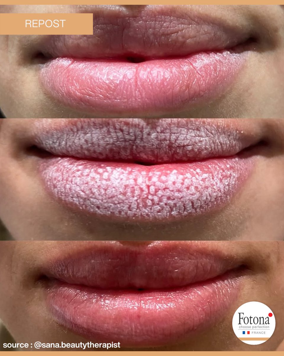 DermatoFotona's tweet photo. Repost - LipLase
Respot : @sana.beautytherapist

Achieve Naturally Plump Lips with Fotona LipLase 💋

#FotonaLipLase #NonInvasiveBeauty #PlumpLips #CollagenBoost #NoNeedles #LaserTreatment #LipGoals #NaturalBeauty #BeautyInnovation #SkinCareSolutions #GlowUp https://t.co/57NGU2REuP
