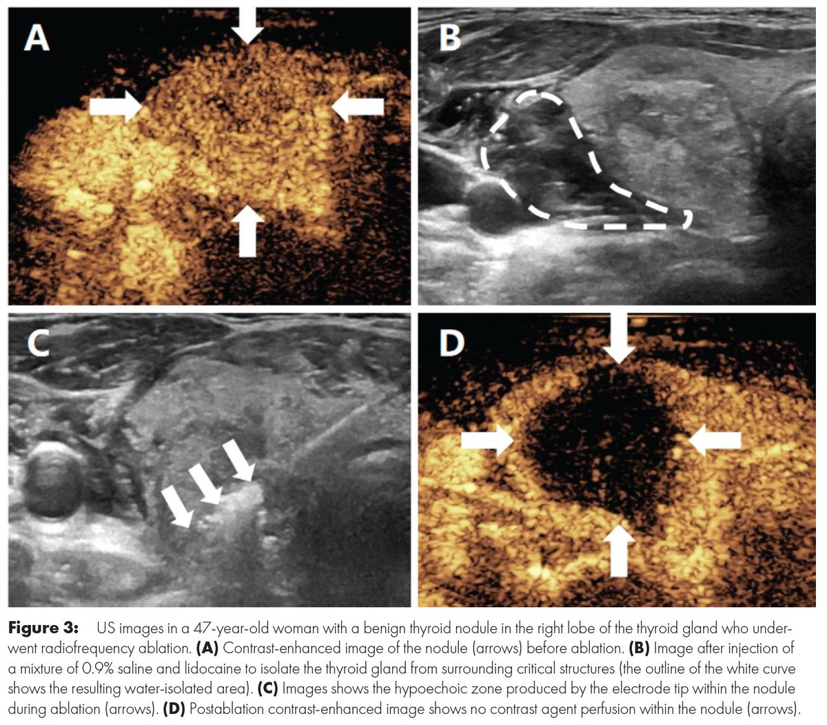 RadIC_Editor's tweet photo. 🔥 Hot off the press from Radiology: Imaging Cancer:

"Safety and Efficacy of Thermal Ablation for Benign Thyroid Nodules in Patients with or without Previous  Thyroid Surgery" by Lu et al.

Full Article: https://t.co/OtoM0zZbpi

#ImagingCancer #Cancer https://t.co/6s9p5qwKDp