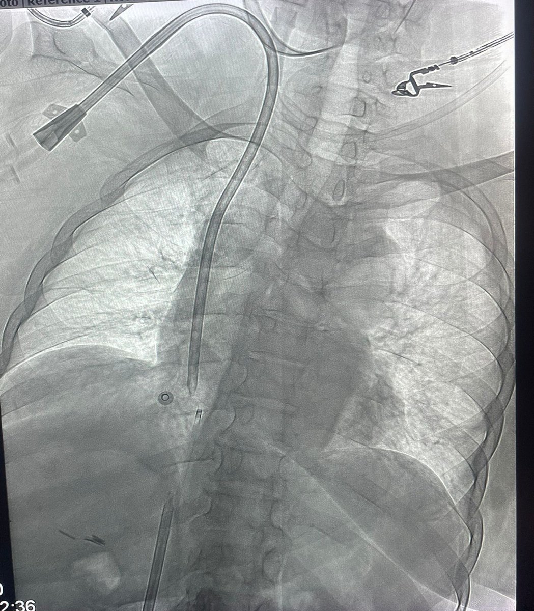 That Permacath should find its way in. #irad