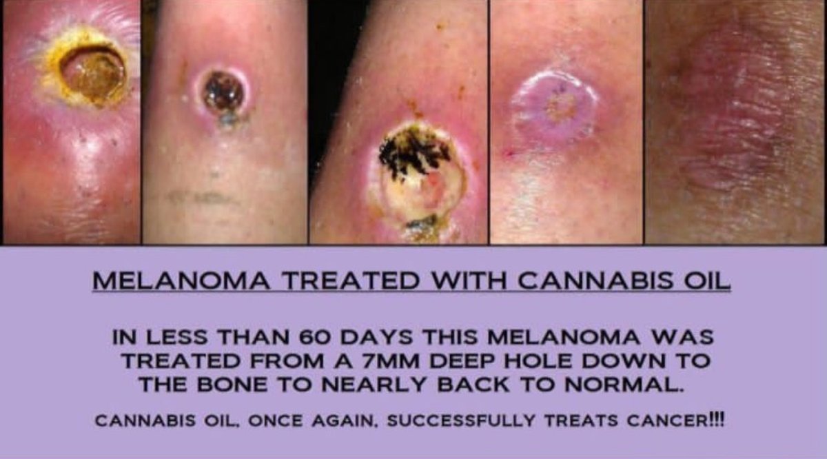 mcgillmedicines's tweet photo. When used topically, cannabis oil has be shown to cure skin cancer. Cannabis oil can also cure other forms of cancer. For more information check out https://t.co/LQ7BxPFwug and research #CBDoil and #RickSimpsonOil https://t.co/XCtH9PcHrS