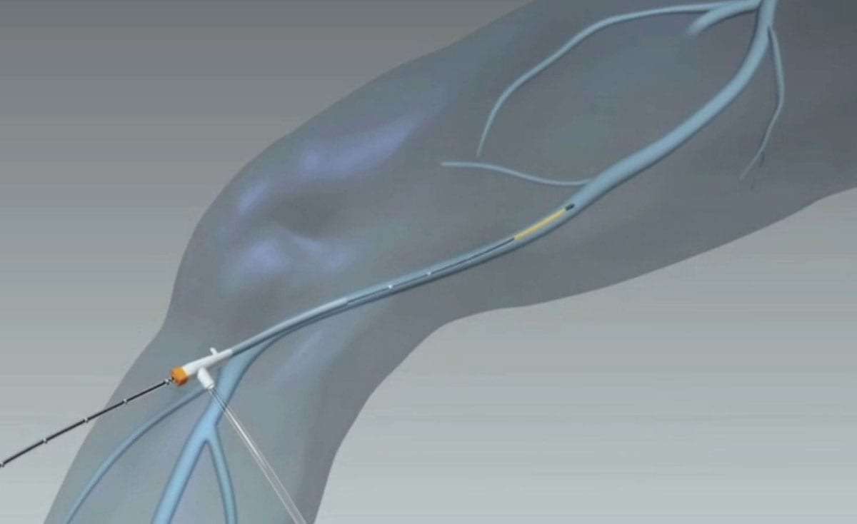 novusspine's tweet photo. ClosureFast is a minimally invasive procedure is an effective pain management treatment for varicose veins and venous insufficiency. #pain 
https://t.co/q7ZSdPxsym https://t.co/Ot2G0qdbOm