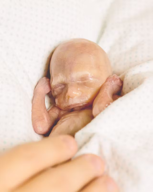 LiveAction's tweet photo. Chase and Cooper were identical twins miscarried at 22 weeks.

Their mother chose to share their photos, saying, “...I want people to know that this is what a 22-week-old child looks like.” https://t.co/WZ0G7LfWH4
