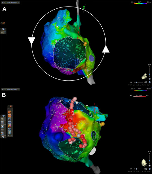 Catheter ablation of macro-reentrant atrial tachycardia in adults with Ebstein anomaly: A narrative review, by <a href="/norman_c_wang/">Norman C. Wang, MD, MS</a> and colleagues
<a href="/PittCardiology/">Pitt Cardiology</a> <a href="/PittPediatrics/">Pitt Department of Pediatrics</a> #EPeeps
heartrhythmopen.com/article/S2666-…