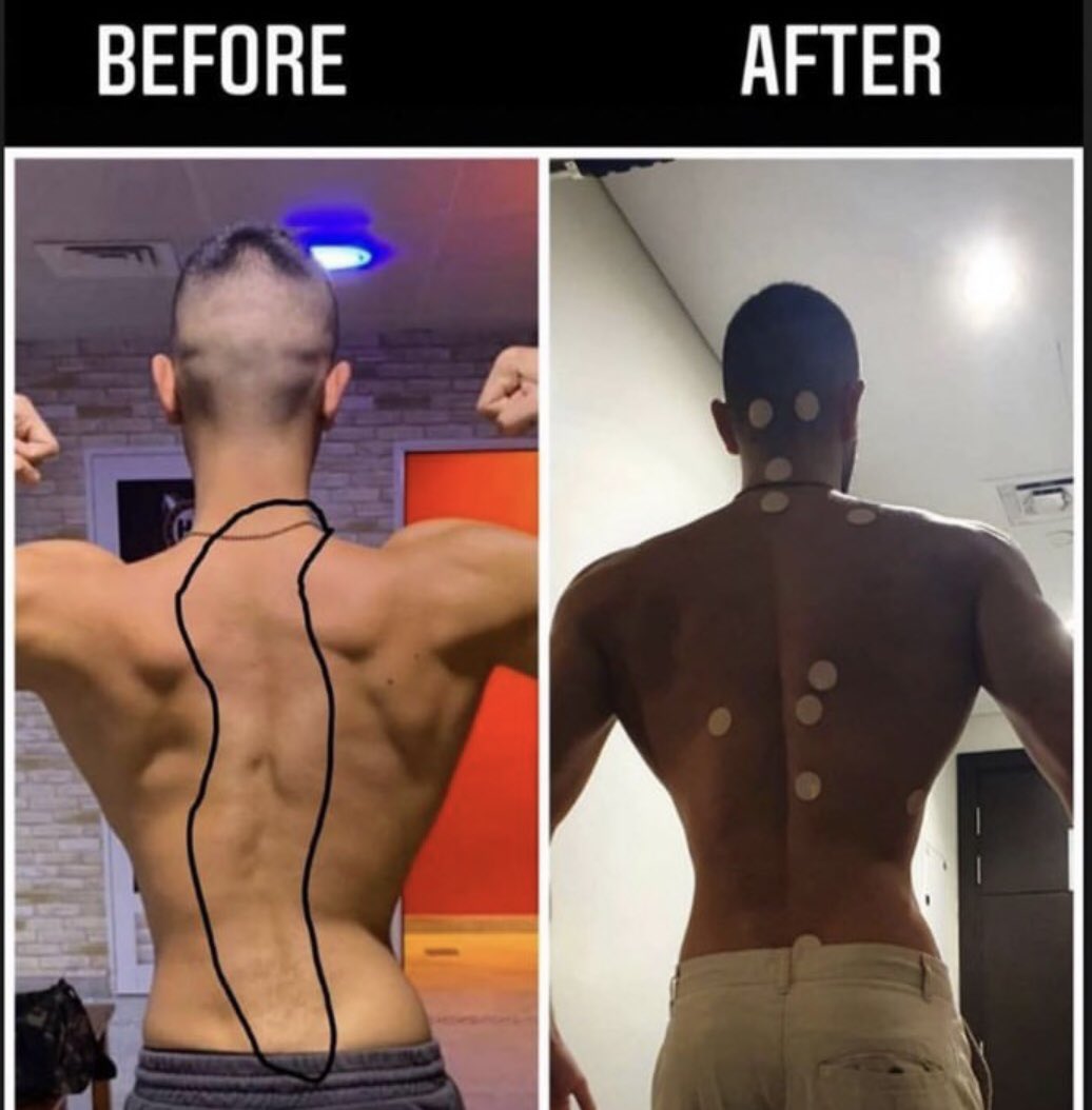 Scoliosis challenge: Can your method do this?
Back pain → gone
Spine → realigned
ANF Therapy delivered.
Now show us your approach 💪
#ScoliosisTransformation #ANFTherapy #Beckysangels #CHANELSS26 #GMMTVFANIVALxPerthSanta #Lebron #Healthcare #FitnessMotivation #FitnessJourney