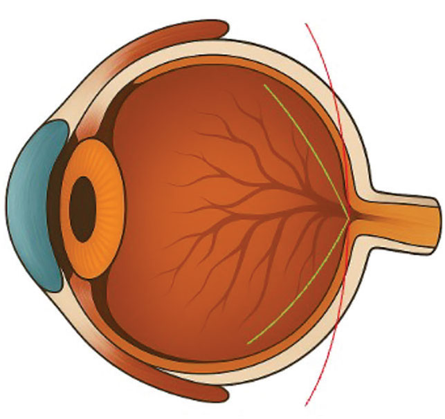 revoptom's tweet image. Which Matters More: Reducing Axial Length or Refractive Error Progression?
It is imperative for clinicians to understand which changes in these values are meaningful to a patient’s myopia treatment: reviewofoptometry.com/article/which-…
#myopia #myopiacontrol #myopiamanagement #eyecare