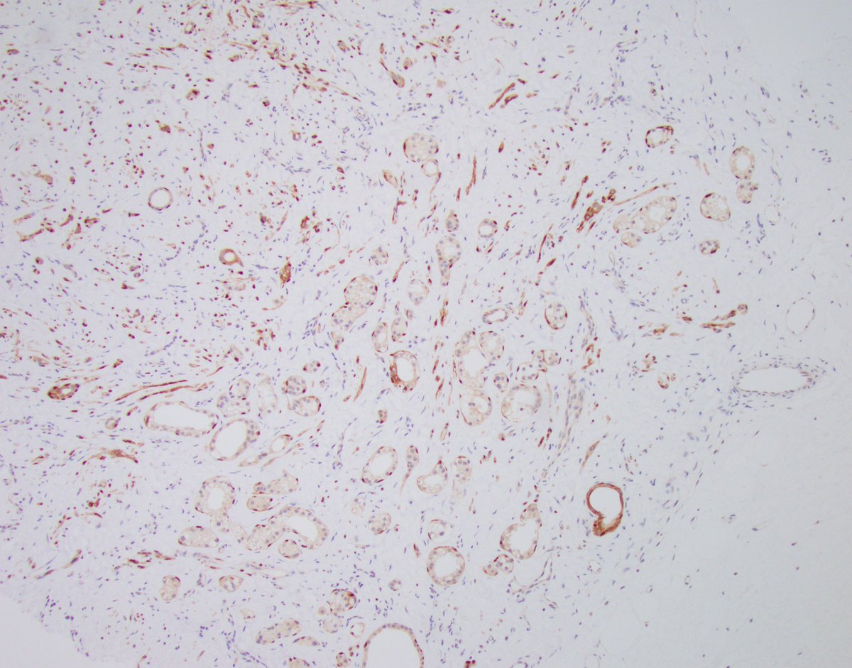 Welcome to Breast Consult Case of the Week 6! #BCCW6 #breastpath

Some diagnoses decidedly follow me everywhere I go. Or I may just be overdiagnosing them :) 

This patient has an invasive ductal carcinoma, grade 1/3, at another location in the same breast. The consulting