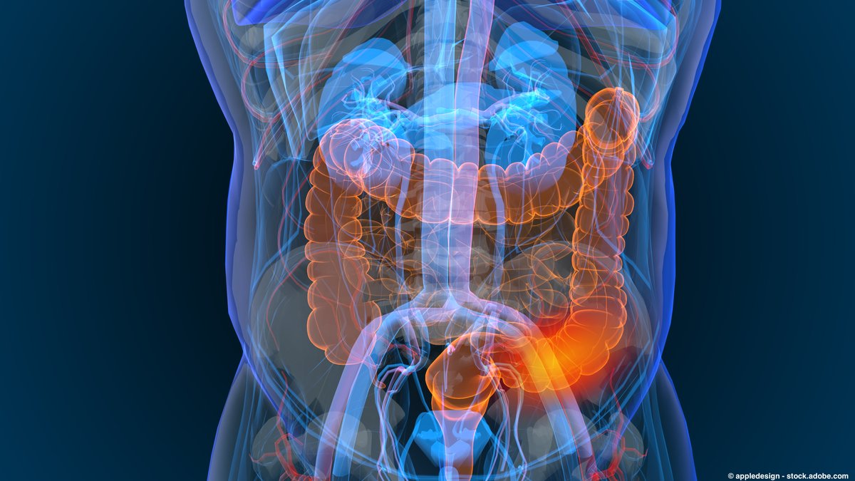 OncLive's tweet image. The latest screening algorithm for Shield for patients with #CRC demonstrated a sensitivity of 84% for detecting the cancer with 90% specificity, including a sensitivity of 62% for detecting stage I #CRC.
Read the article: onclive.com/view/shield-bl…