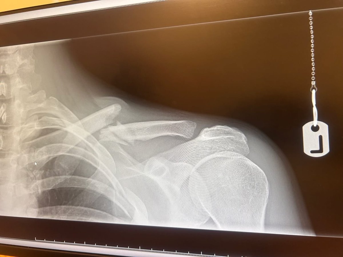 12 months ago, almost to the hour I was laying with my head strapped between two blocks waiting for the results of a CT scan. Fortunately no broken back or damage to the head, just a broken collar bone and 5 ribs… #roadcycling