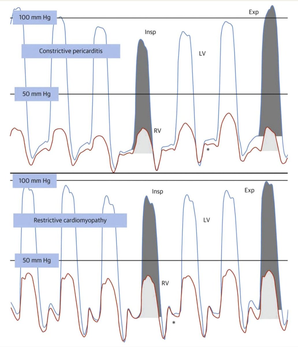 javier20ch's tweet photo. Evaluación hemodinámica para diferenciar entre Pericarditis Constrictiva 🆚️ Miocardiopatía Restrictiva. 🤨🔎🫀💢⁉️
🔶️Mediante una evaluación invasiva, la MCR se caracteriza por presiones de llenado diastólico elevadas y una rápida igualación de las presiones de llenado de las 4 cámaras durante la diástole, con un patrón frecuente de "caída y meseta" o "raíz cuadrada" (dip-plateau) en los trazos de presión.
🔶️Este patrón se hace mas evidente con maniobras que aumentan el llenado ventricular, como la infusión de volumen, elevación de las piernas o inspiración profunda.
✔️Pericarditis Constrictiva: signo raíz cuadrada〽️ con descenso (dip) mas rápido, mayor interdependencia ventricular (mas notoria), igualación casi completa de las presiones diastólicas (diferencia de VI y VD es <5 mmHg).
✔️Miocardiopatía Restrictiva: signo raíz cuadrada〽️ con descenso (dip) menos pronunciado, menor interdependencia ventricular (menos notoria), igualación de las presiones diastólicas pero suele haber mayor diferencia (VI > VD por >5 mmHg).

https://t.co/XowDKM09uJ
https://t.co/KibVpIA1Mh
