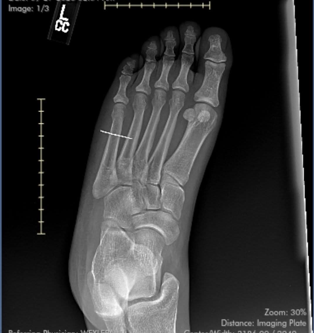 MrsNerdi's tweet photo. Stepped on a sewing NEEDLE ..got it lodged in my foot.....had to have emergency..cant walk on it for 4 weeks ....who wants to send me dinner @ChipotleTweets @Popeyes @ChickfilA @UberEats @DoorDash @raisingcanes #Walmart @Walmart @Popeyes #hungry #FeedMe #sstvi https://t.co/INzYf71OT1