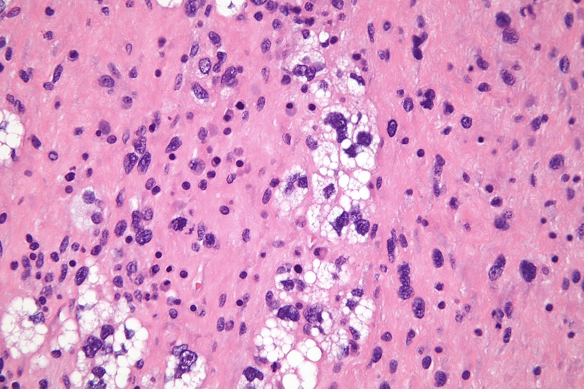 surgpathcases's tweet photo. Thigh, 70y

#pathology #patologia #pathoutpic #bstpath https://t.co/qymC8u9yW5