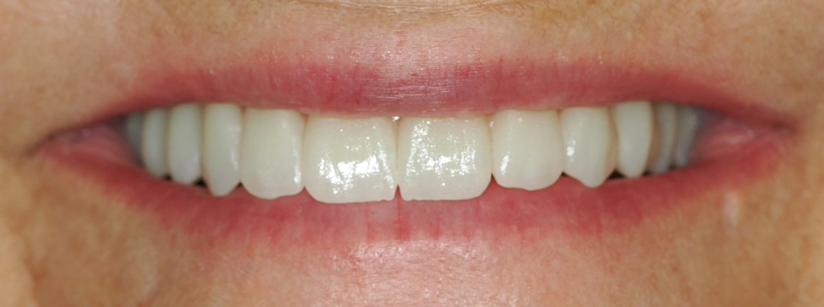 ¡Sonríe con confianza gracias a la <a href="/ClnicaBowen/">Clínica Bowen</a> ! 😁 Nuestro proceso personalizado, desde el estudio del caso hasta el molde final, crea sonrisas perfectas como ésta 🦷 ¿List@ para transformar tu boca? Contacta con nosotros en el 📞 913992730

#SonrisaPerfecta #CuidarteEsSalud