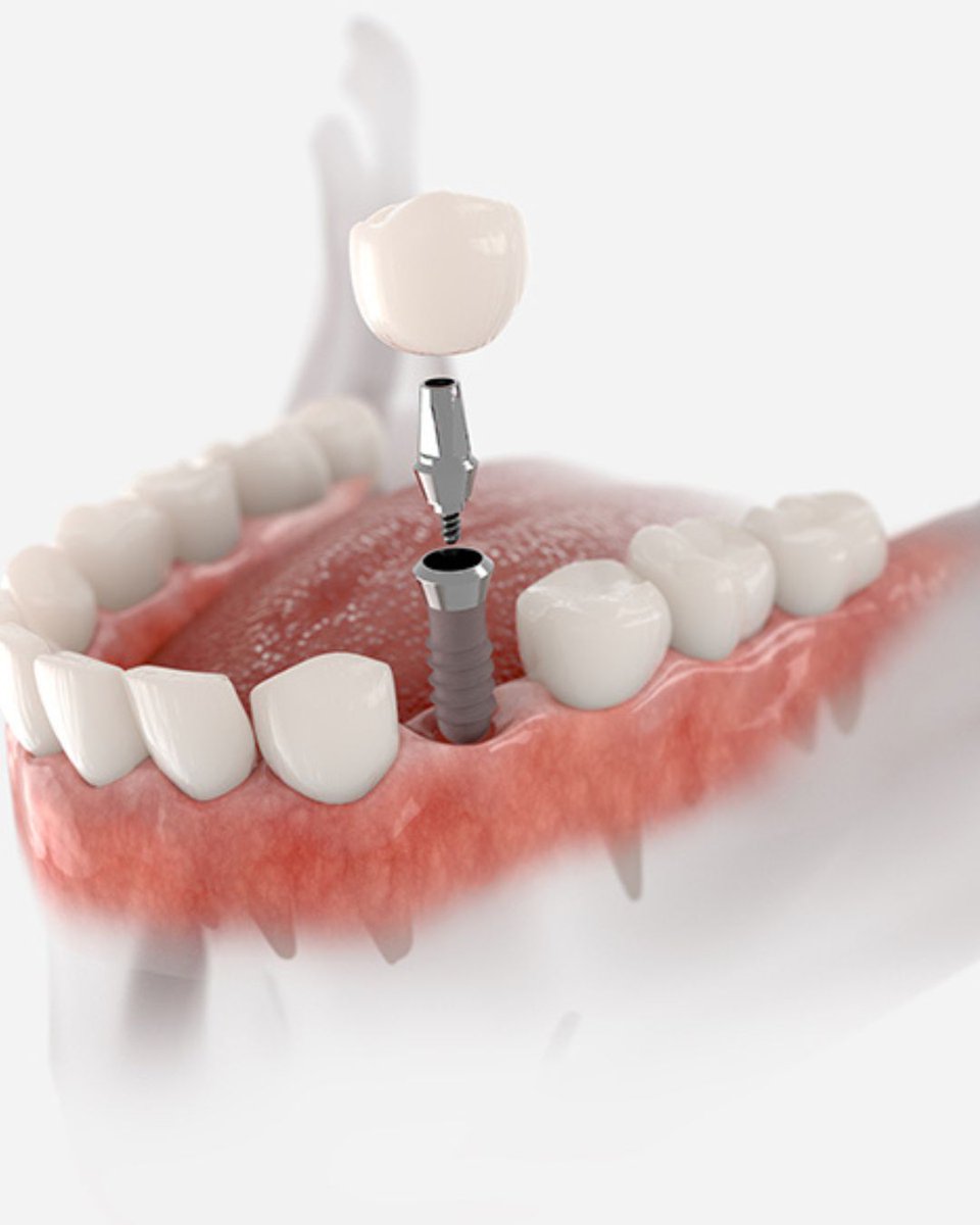ScottsDentistry's tweet photo. Missing just one tooth? You don’t need to live with the gap!

A single dental implant is a long-lasting, natural-looking solution that restores your smile — and your confidence.

💻 https://t.co/vdlkP4vbRP
#ScottsdaleCenterForImplantDentistry #DentalImplant #MissingTooth https://t.co/WviwVHLtUq