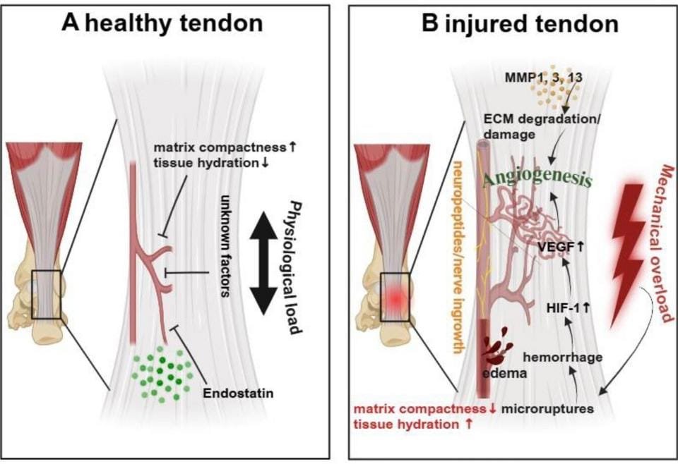 Healthy Vs Injured Tendon

<a href="/Retlouping/">ɹǝʇlnoԀ pıʌɐᗡ 🚴🏻 🇺🇸 🇦🇺 🇬🇧</a> <a href="/PhysioMeScience/">Physio Meets Science</a> <a href="/TDekkersPhysio/">Thomas Dekkers | Spinal Specialist Physiotherapist</a> 

advanced.onlinelibrary.wiley.com/doi/full/10.10…