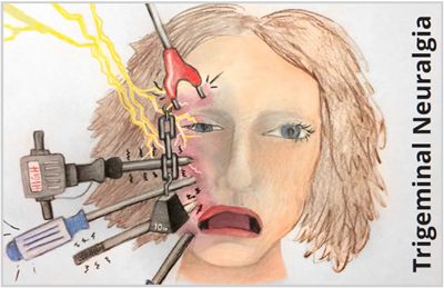 leo_veritas's tweet image. Tristemente, es un dolor que atraviesa huesos, nervios y paciencia.
 #Diainternacionalneuralgiatrigemino
#trigeminalneuralgiaawarenesday