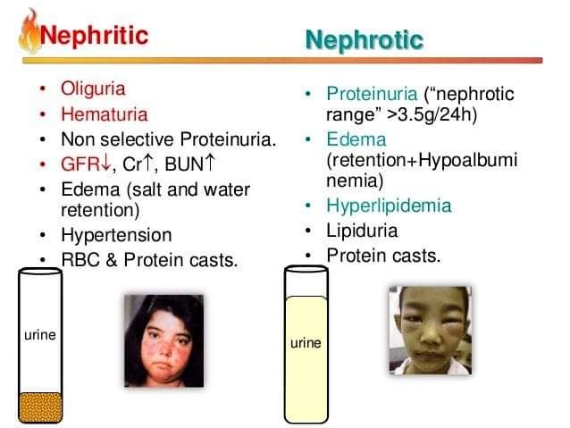 Nephritic Vs Nephrotic syndrome