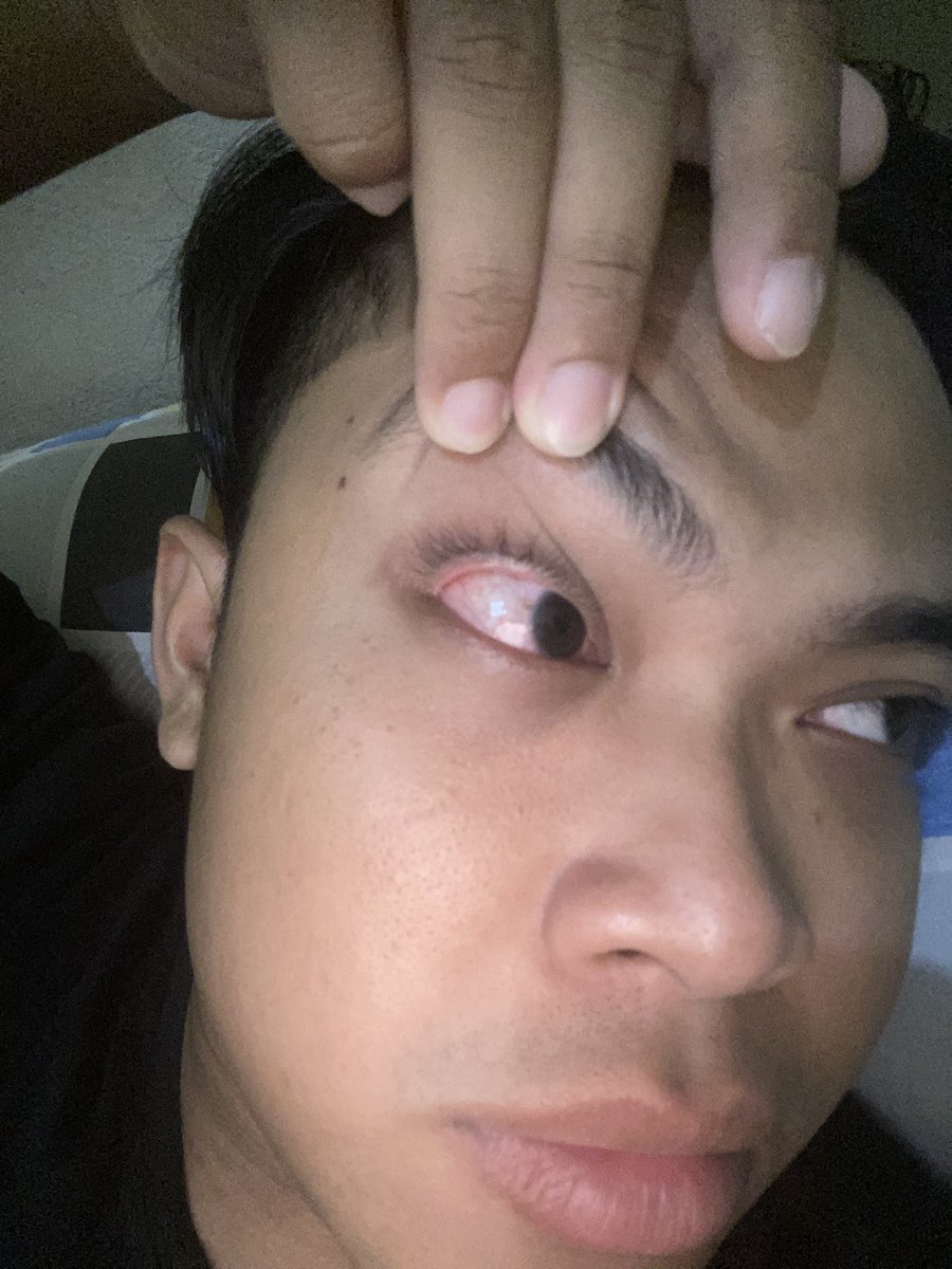 ZeedHuruf's tweet photo. infeksi kornea. kenapa si ini udara diindo? tahun ini balik 2x, tiap balik sakit mata, pas periksa langsung diagnosa “wah ini infeksi kornea mas��. pas puasa kmrn yg kanan, skrg yg kiri. 

infeksi kornea karna apa ya dok?
“ini penyebab utamanya karna bakteri”

khoir, doain gaiss https://t.co/jyKCiNiDjP