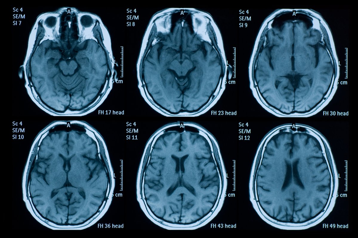 CSIC en Catalunya (@csiccat) on Twitter photo Descoberta una molècul·la de 4 aminoàcids amb activitat terapèutica en #lesionscerebrals, sense afegir fàrmacs
S’acumula selectivament en el teixit cerebral lesionat en models animals, el que suggereix que podria funcionar en humans
<a href="/EMBO/">EMBO</a>
<a href="/IQAC_CSIC/">Institute for Advanced Chemistry of Catalonia</a>
delegacion.catalunya.csic.es/descobreixen-u… Descoberta una molècul·la de 4 aminoàcids amb activitat terapèutica en #lesionscerebrals, sense afegir fàrmacs
S’acumula selectivament en el teixit cerebral lesionat en models animals, el que suggereix que podria funcionar en humans
<a href="/EMBO/">EMBO</a>
<a href="/IQAC_CSIC/">Institute for Advanced Chemistry of Catalonia</a>
delegacion.catalunya.csic.es/descobreixen-u…
