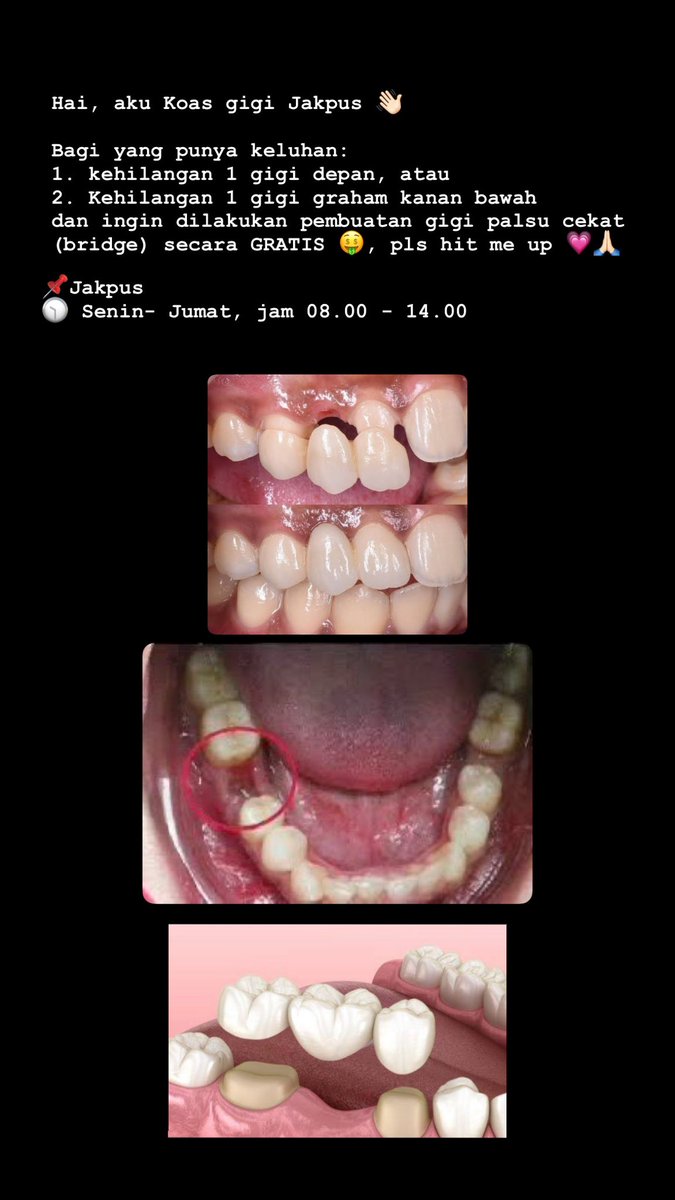GigiKoas's tweet photo. GIGI PALSU (BRIDGE) GRATIS 🤑🦷
Bagi yang punya keluhan seperti gambar di bawah, dm yaa 🥰🙏🏻
#koasgigijakarta #perawatangigigratis #gigipalsugratis https://t.co/9xUenbBD6t