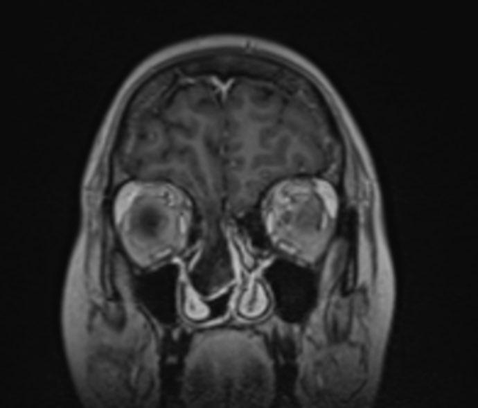 Jacques_Robin's tweet image. 🔍 Case of the Day | The Value of MRI in Recurrent Meningitis
A 29-year-old female presents with recurrent episodes of meningitis, without prior trauma or surgery. Clinical suspicion: occult anterior skull base defect.
🩻 MRI Brain:
• Cribriform plate defect measuring 9.8 ×…