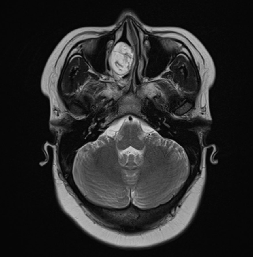Jacques_Robin's tweet image. 🔍 Case of the Day | The Value of MRI in Recurrent Meningitis
A 29-year-old female presents with recurrent episodes of meningitis, without prior trauma or surgery. Clinical suspicion: occult anterior skull base defect.
🩻 MRI Brain:
• Cribriform plate defect measuring 9.8 ×…