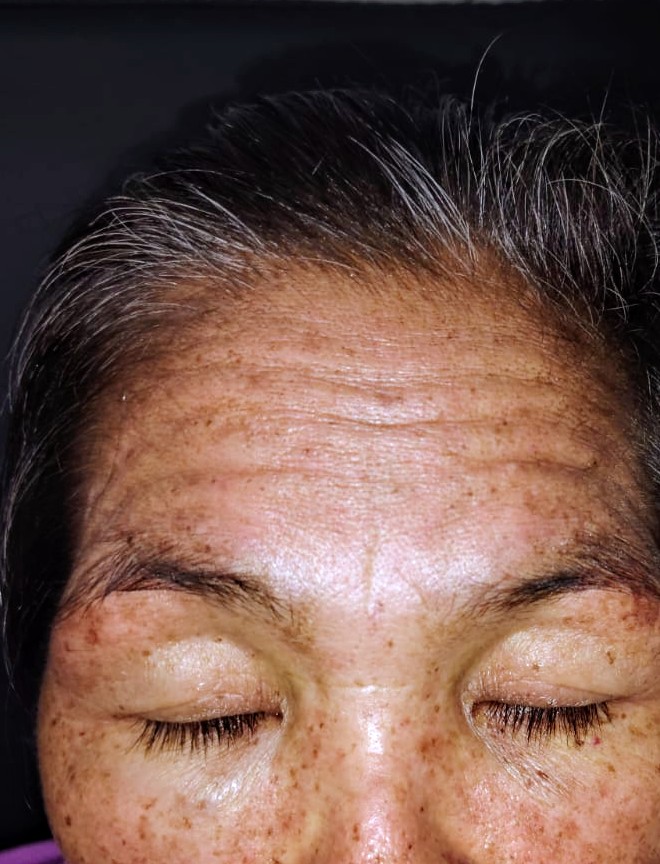 ConsejosReumato's tweet image. Mujer 56 años con #dermatomiositis , vean lesiones hipercrómicas en la frente, mejoró con #corticoides . A los 14 años desarrolló #tuberculosis pulmonar que dejó como secuela gran colapso pulmonar que retrae corazones y tráquea. #chest #dermatomyositis #muscle