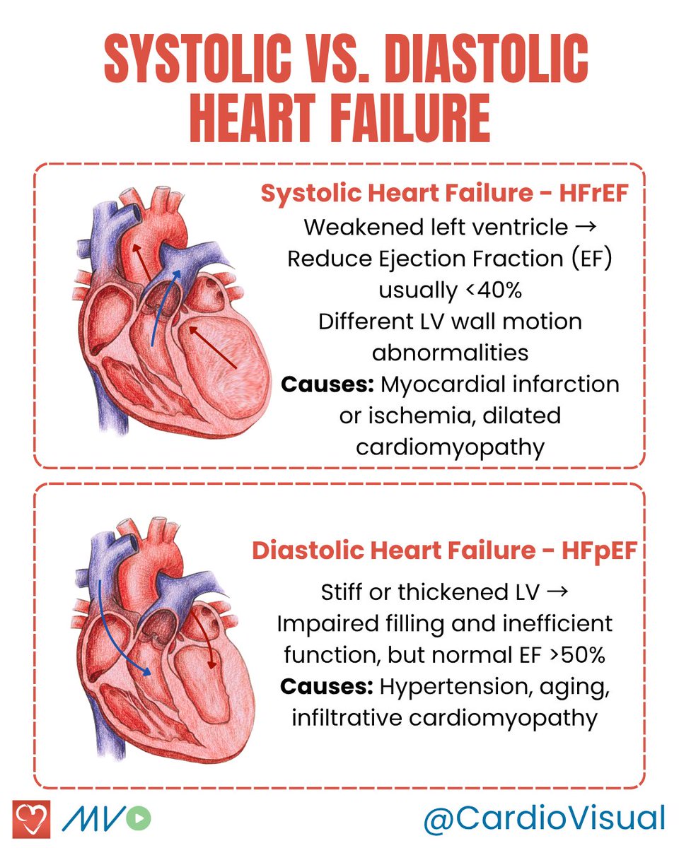 CardioVisualApp's tweet image. 👉Systolic (HFrEF) presents with weak LV, low EF, and a dilated chamber.
👉Diastolic (HFpEF) presents with stiff LV, normal EF, preserved size.
The new nomenclature is HFrEF and HFpEF, but they are generally related to systolic and diastolic HF.
#HeartFailure #Cardiology