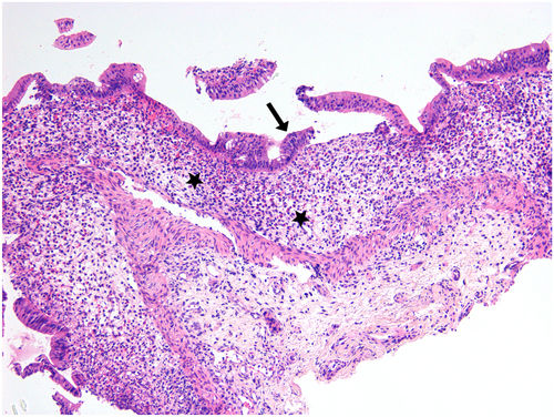 JPGNReports's tweet photo. From @hug_ge 

Severe cow’s milk protein #allergy can cause protein-losing enteropathy #PLE and dramatic GI changes—even without clear endoscopic clues! 🍼🩺 
Always consider #CMPA in infants with #hypoalbuminemia. 
#GITwitter #FoodAllergy #MedTwitter 

🔗 https://t.co/Roqni5L3ae https://t.co/abUpfB3Kqq