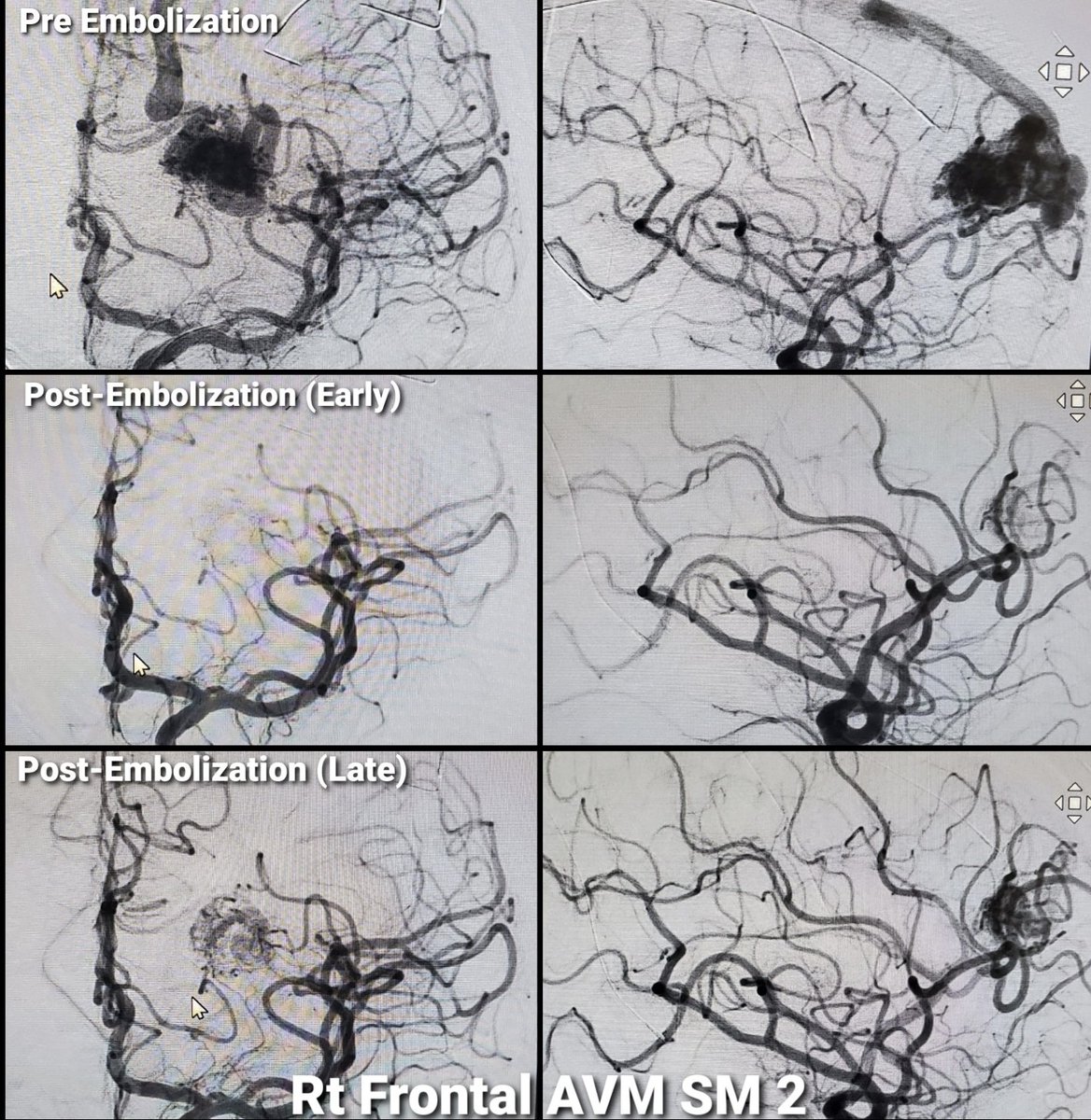 almuftifawaz's tweet photo. What do you quote as the incidence of #AVM rupture to your patients?

Old school: “105 – age” rule of thumb → lifetime risk
Practice: 2–4%/yr

MARS study (@JAMANeuro, Oct 2025):
3,030 pts → 159 bleeds / 11,339 person-years
= ~1.4%/yr (95% CI 1.2–1.6)

Risk ↑ with:
Older age
Associated aneurysms
Deep supratentorial /cerebellar AVM

About 1–2/100 patients bleed each year = More precise data for counseling.

Full article: https://t.co/BIXZRZR2r0

Thoughts: @PascalJabbourMD @elghanemmoh @AmeerEHassan  @_AdnanSiddiqui @TareqKass @AlAlBayati1