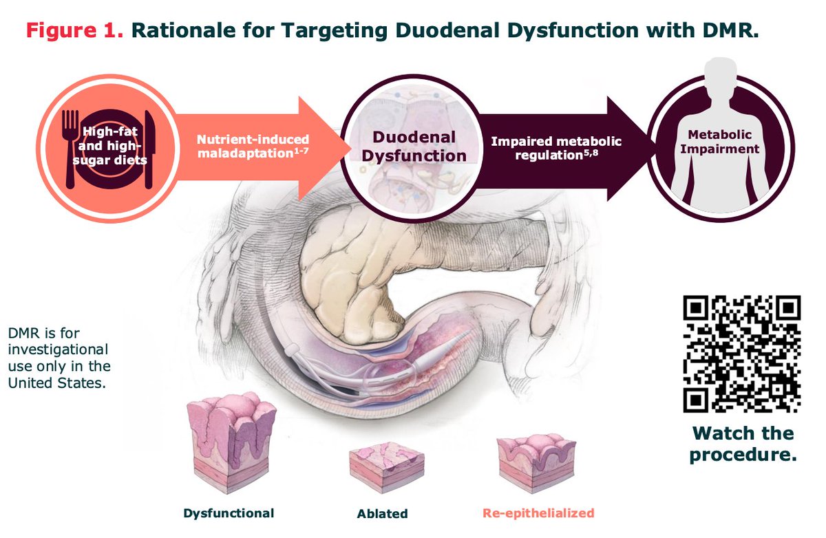 Vulpescap's tweet image. $GUTS long-form thesis:

I once missed the feast of the weight-loss craze,
GLP-1s set the market ablaze.
Too crowded, too rich, too many to name,
I watched from afar—yet felt the flame.

Then came Fractyl, a different way,
A duodenal tune-up to keep fat at bay.
No needles, no…