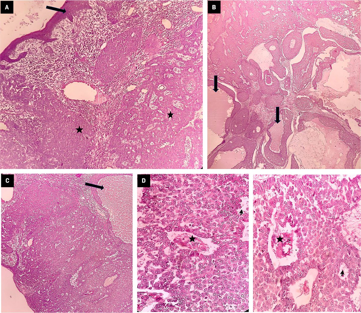 Applied_RadOnc's tweet image. Case Report: A Rare Case of Sweat Gland Carcinoma of the Breast
💗🔗 ow.ly/k8zo50X7kqu
#BCAM25 #BreastCancerAwarenessMonth #WomensHealth #RadOncEd #MedEd