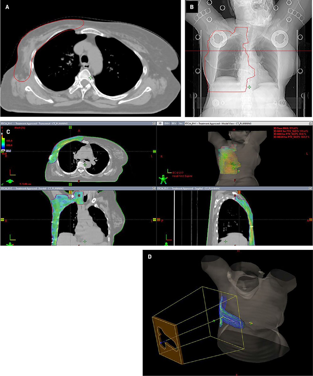 Applied_RadOnc's tweet image. Case Report: A Rare Case of Sweat Gland Carcinoma of the Breast
💗🔗 ow.ly/k8zo50X7kqu
#BCAM25 #BreastCancerAwarenessMonth #WomensHealth #RadOncEd #MedEd