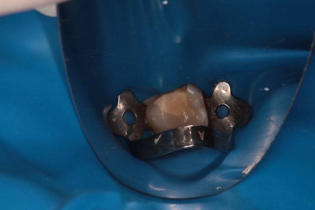 dentist_amar617's tweet image. الم يصحي  من النوم لسن معمول له حشوة  من فتره وانكسرت ادى الى التهاب العصب ويتطلب  علاجه
Rct for #16 diagnosed  with irreversible pulpitis  
Cannal were naro and prepared  woth taper 4 files
#saveatooth  #endodonticslife