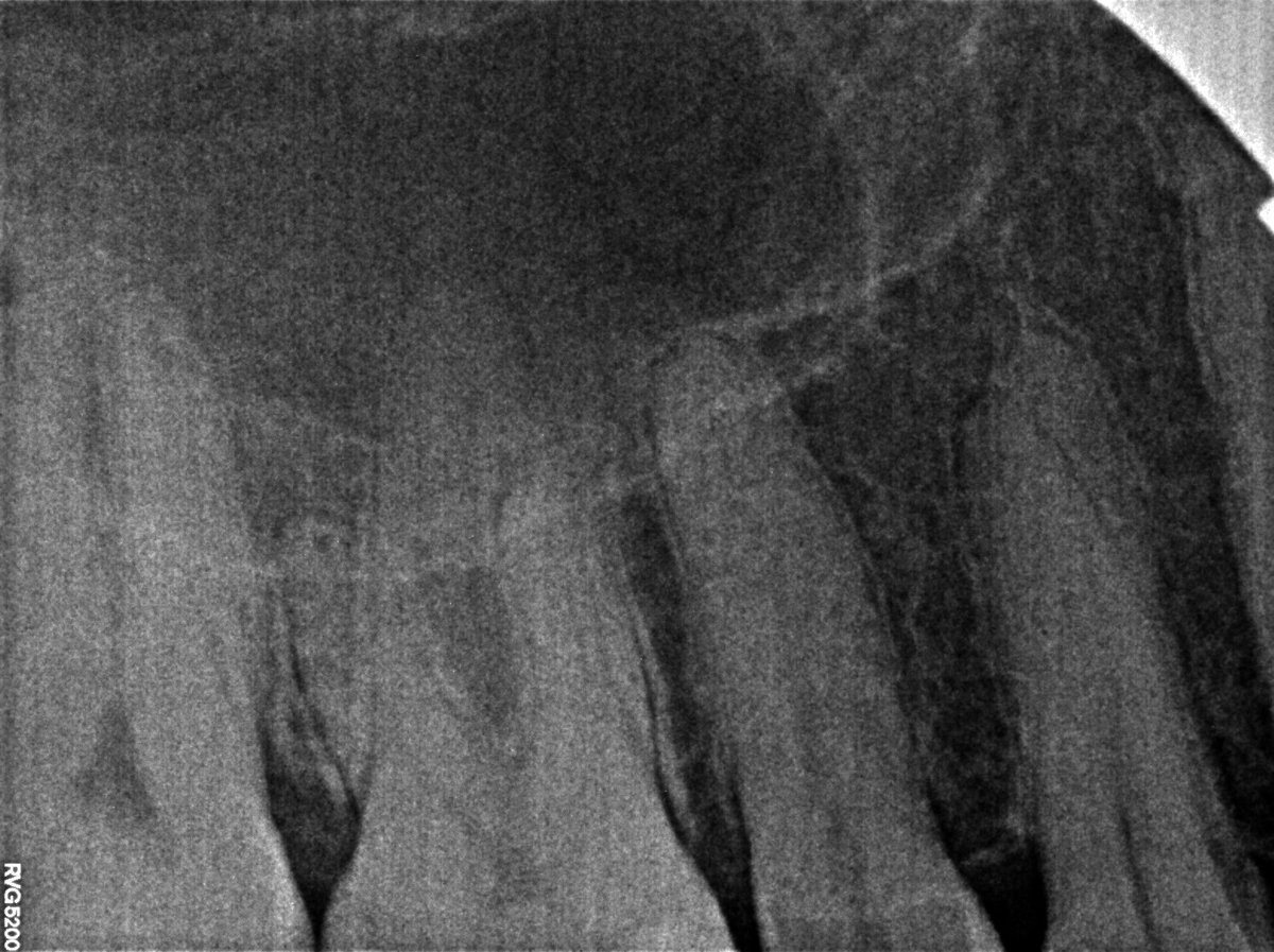 dentist_amar617's tweet image. الم يصحي  من النوم لسن معمول له حشوة  من فتره وانكسرت ادى الى التهاب العصب ويتطلب  علاجه
Rct for #16 diagnosed  with irreversible pulpitis  
Cannal were naro and prepared  woth taper 4 files
#saveatooth  #endodonticslife