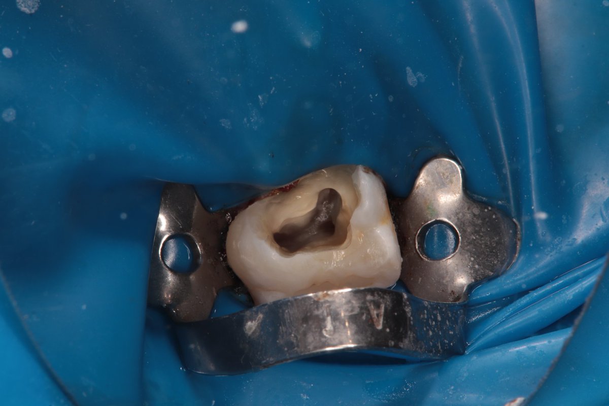 dentist_amar617's tweet image. الم يصحي  من النوم لسن معمول له حشوة  من فتره وانكسرت ادى الى التهاب العصب ويتطلب  علاجه
Rct for #16 diagnosed  with irreversible pulpitis  
Cannal were naro and prepared  woth taper 4 files
#saveatooth  #endodonticslife