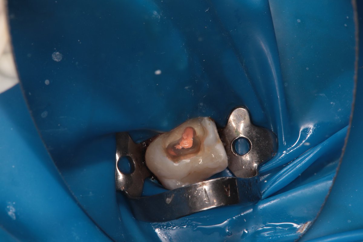 dentist_amar617's tweet image. الم يصحي  من النوم لسن معمول له حشوة  من فتره وانكسرت ادى الى التهاب العصب ويتطلب  علاجه
Rct for #16 diagnosed  with irreversible pulpitis  
Cannal were naro and prepared  woth taper 4 files
#saveatooth  #endodonticslife