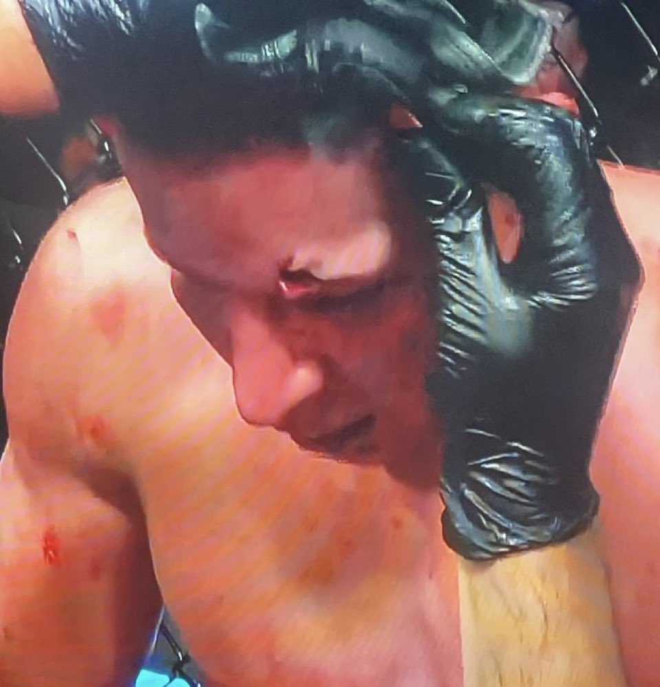Fight_Algorithm's tweet image. “There’s a hole in his head”
#UFC #DWCS #FightAlgo
