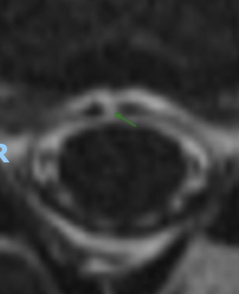 Can see this being the future of ventral leak Dx. 

Up to engineers to make it more practical. Here 6-7 min for 15 cm of coverage