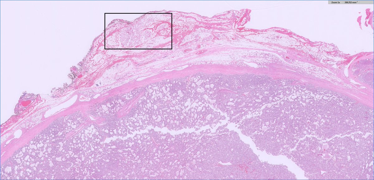 slusagar's tweet image. interesting #endopath/#GUpath adrenal🔬:

pheochromocytoma with brown fat in surrounding adipose tissue

@AMubeen_Path @DrCristinaMagi had a nice @TheUSCAP abstract on this topic a few years back